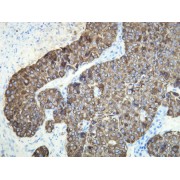 IHC-P analysis of CK18 expression in the adenosquamous carcinoma of the human pancreas (4 µm section).