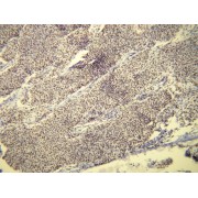 IHC-P analysis of diffuse nuclear progesterone receptor (PR) expression in meningothelial meningioma (4 µm section).