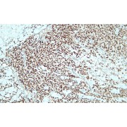 IHC-P analysis of human melanoma tissue (4 µm section), using SOX10 monospecific antibody, showing strong distinct nuclear SOX10 expression.