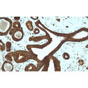 IHC-P analysis of human breast carcinoma tissue (4 µm section), using Cadherin 1 monospecific antibody, showing strong membranous Cadherin 1 expression.