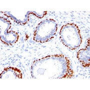 IHC analysis of formalin-fixed paraffin-embedded prostate carcinoma, using p40 antibody.