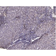 IHC-P analysis of Human liver cancer tissue, using CACNA1A Antibody (1/200 dilution).