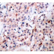 IHC-P analysis of human breast carcinoma tissue using Phospho-BCL2-T56 antibody (abx000364). Microwave antigen retrieval was performed with 10 mM Tris/EDTA, pH 9.0, prior to IHC.