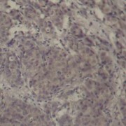 Immunohistochemistry of paraffin-embedded human breast carcinoma using Phospho-CREB1-S142 antibody (abx000382).