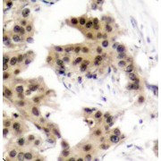 Immunohistochemistry of paraffin-embedded human breast carcinoma using Phospho-NFKB1-S893 antibody (abx000462).