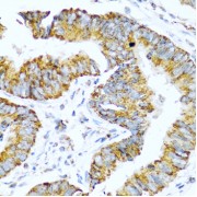 Immunohistochemistry of paraffin-embedded human colon carcinoma using GCG antibody (abx001034) at dilution of 1/100 (40x lens).