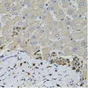 Immunohistochemistry of paraffin-embedded human liver injury using S100A12 antibody (abx004073) at dilution of 1/100 (40x lens).