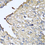 Immunohistochemistry of paraffin-embedded human prostate cancer using ASIP antibody (abx005235) at dilution of 1/100 (40x lens).