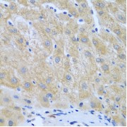 Immunohistochemistry of paraffin-embedded human liver cancer using FURIN antibody (abx006007) at dilution of 1/100 (40x lens).