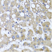 Immunohistochemistry of paraffin-embedded human liver injury using TTLL12 antibody (abx006097) at dilution of 1/100 (40x lens).