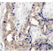 Immunohistochemistry analysis of paraffin-embedded Human breast carcinoma using Phospho-c-Abl-Y412 Antibody. Microwave antigen retrieval performed in 0.01 M Tris/EDTA Buffer (pH 9.0) prior to IHC staining.