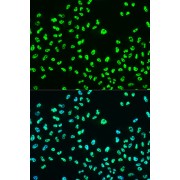 Immunohistochemistry analysis of paraffin-embedded Human breast cancer tissue using Phospho-BRCA1-S988 Antibody at a dilution of 1/100 (40x lens). High pressure antigen retrieval was performed in 0.01 M Tris-EDTA buffer (pH 9.0) prior to IHC staining.