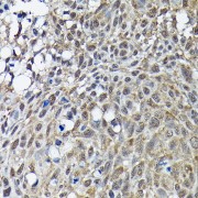 Immunohistochemistry analysis of paraffin-embedded Human lung cancer using BRCA1 Antibody at dilution of 1/100 (40x lens). High pressure antigen retrieval performed in 0.01 M Citrate buffer (pH 6.0) prior to IHC staining.