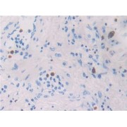 IHC-P analysis of Human Lung cancer Tissue, with DAB staining.