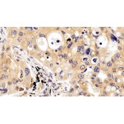 IHC-P analysis of Human Lung cancer Tissue, with DAB staining, using Mouse Anti-Human MAPT Antibody (20 µg/ml) and HRP-conjugated Goat Anti-Mouse antibody (<a href="https://www.abbexa.com/index.php?route=product/search&amp;search=abx400001" target="_blank">abx400001</a>, 2 µg/ml).