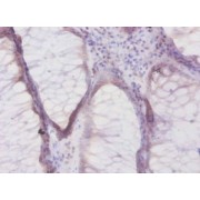 Immunohistochemical analysis of paraffin-embedded Human coloorectal cancer tissue using DEFB1 antibody (1/50 dilution).