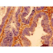 IHC-P analysis of human colon cancer tissue, using BTF3 antibody (1/100 dilution).