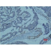 Immunohistochemistry analysis of paraffin-embedded human colon caricnoma using Survivin Monoclonal Antibody.