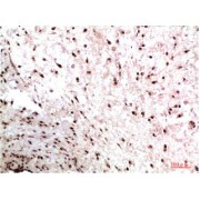 Immunohistochemistry analysis of paraffin-embedded Human Colon Carcinoma Tissue using HP-1γ Mouse mAb diluted at 1/200.