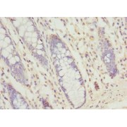 Immunohistochemistry of paraffin-embedded human colon cancer using SEC61G Antibody at a dilution of 1:100