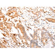 IHC-P analysis of human colon cancer tissue, using ABCA4 antibody (1/30 dilution, 200x magnification).