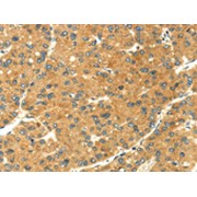 IHC-P analysis of Human liver cancer tissue, using SEMA4C antibody (1/20 dilution, x200).