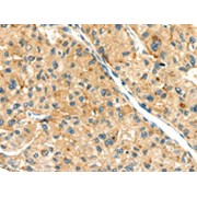 IHC-P analysis of Human liver cancer tissue, using SEMA4C antibody (1/30 dilution, x200).