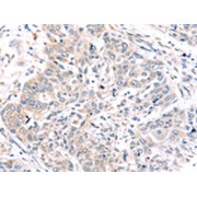 IHC-P analysis of human lung cancer tissue (1/45 dilution, 200x magnification)