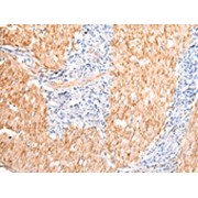 IHC-P analysis of Human gastric cancer tissue, using DMBT1 Antibody (1/20 dilution, x200 lens).