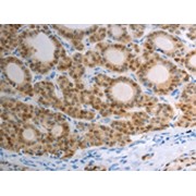 IHC-P analysis of paraffin embedded human thyroid cancer tissue, using S100A1 Antibody (1/40 dilution, 200X magnification).