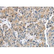 IHC-P analysis of human liver cancer tissue, using IGFBP4 antibody (1/35 dilution, original magnification 200X).