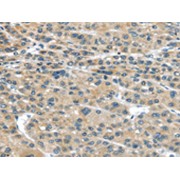 IHC-P analysis of human liver cancer tissue, using IGFBP4 antibody (1/25 dilution, original magnification 200X).