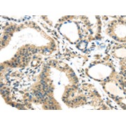 IHC-P analysis of human thyroid cancer tissue, using BOK antibody (1/35 dilution).