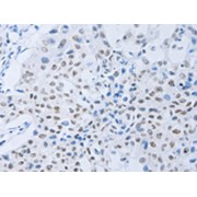 IHC-P analysis of Human lung cancer tissue using Colony Stimulating Factor 1 Receptor Antibody (1/45 dilution, x200 magnification).