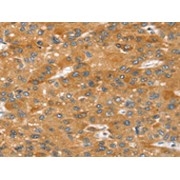 IHC-P analysis of human liver cancer tissue, using SRGAP2 antibody (1/20 dilution, 200x magnification).