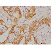 Immunohistochemistry analysis of RARA Antibody diluted at 1/155 and staining in paraffin-embedded human breast cancer. After dewaxing and hydration, antigen retrieval was mediated by high pressure in a citrate buffer (pH 6.0). Section was blocked with 10% normal goat serum 30min at RT. Then primary antibody (1% BSA) was incubated at 4°C overnight. The primary is detected by a biotinylated secondary antibody and visualized using an HRP conjugated SP system.