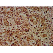 IHC-P analysis of human liver cancer tissue, using DMD Antibody (1/200 dilution). Antigen retrieval was mediated by high pressure in citrate buffer, pH 6.0.