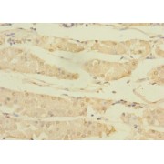 IHC-P analysis of human gastric cancer tissue, using ASTL antibody (1/100 dilution).