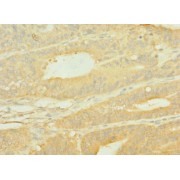 IHC-P analysis of human endometrial cancer tissue, using Ileal Sodium/Bile Acid Cotransporter (SLC10A2) Antibody (1/100 dilution).