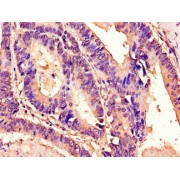 IHC-P analysis f Human colon cancer tissue, using TM4SF20 antibody (1/100 dilution).