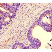 Immunohistochemistry of paraffin-embedded Human ovarian cancer tissue using NBEAL2 Antibody (1/100 dilution, 40x magnification).