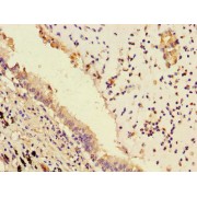 IHC-P analysis of human lung cancer tissue, using PLPP3 antibody (1/100 dilution).