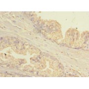 IHC-P analysis of human prostate cancer tissue, using GBP5 antibody (1/100 dilution).