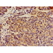 IHC-P analysis of human ovarian cancer tissue, using ANO1 antibody (1/100 dilution).