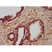 IHC-P analysis of human prostate cancer tissue, using DSC3 Antibody (1/400 dilution).