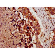 IHC-P analysis of human lung cancer tissue, using CRLF1 antibody (1/300 dilution). After dewaxing and hydration, antigen retrieval was mediated by high pressure in a citrate buffer (pH 6.0). The section was blocked with 10% normal goat serum for 30 min at room temperature. The primary antibody (1% BSA) was then incubated at 4 °C overnight. The primary is detected by a biotin-conjugated secondary antibody and visualized using an HRP-conjugated SP system.