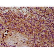 IHC-P analysis of Human ovarion cancer tissue, using EPX Antibody (1/300 dilution).