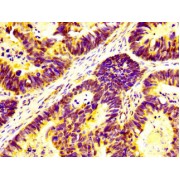 Immunohistochemistry analysis of paraffin-embedded Human ovarian cancer tissue using Ubiquitin Associated Protein 2 Like (UBAP2L) Antibody (1/400 dilution, 1% BSA, 4°C overnight) followed by biotin-conjugated secondary antibody and visualised by an HRP-conjugated SP system. Prior to staining, high pressure antigen retrieval was performed in citrate buffer (pH 6.0) and the section blocked with 10% normal goat serum (RT, 30 min).