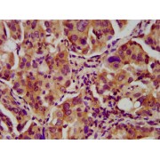 IHC-P analysis of Human lung cancer tissue using Nebulin (NEB) Antibody (1/600 dilution).