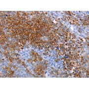 IHC-P analysis of human ovarian cancer tissue, using AQP5 antibody (1/20 dilution, 200x magnification).